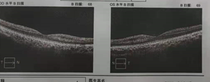 Professor Chen Juan: A Case of Unusual Pediatric Macular Degeneration