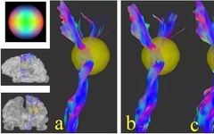 Understanding Q-Space Imaging in Diffusion MRI