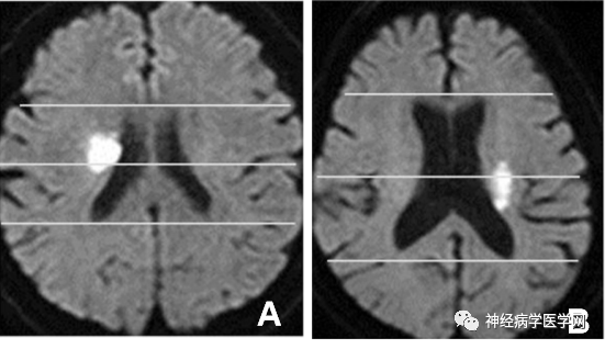 Types of Infarction in Perforating Artery Disease and Advances in Neuroimaging Research