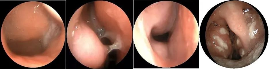 The Past and Present of Secretory Otitis Media in Children
