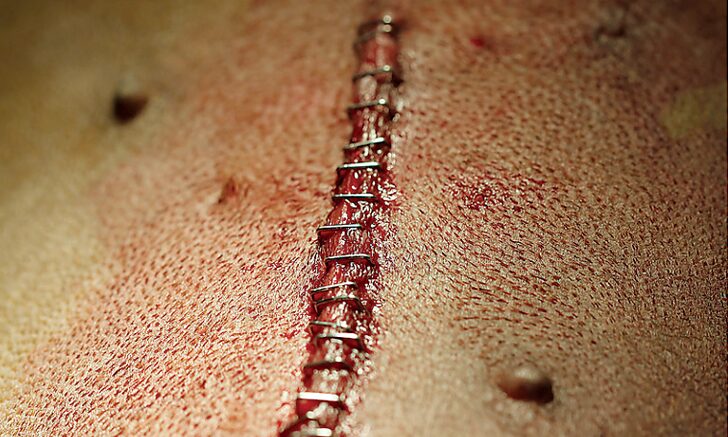 Postoperative Wound Management