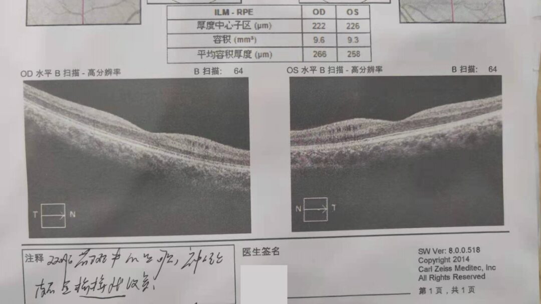 Professor Chen Juan: A Case of Unusual Pediatric Macular Degeneration
