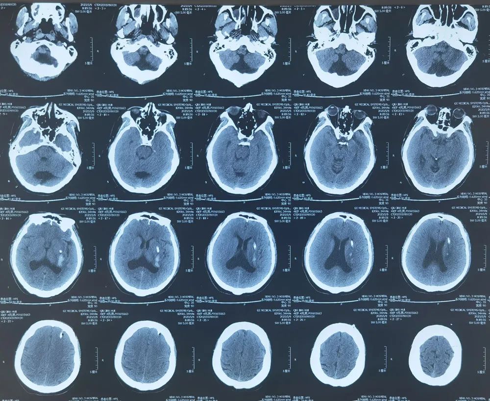 Precision Treatment: Micro-Robots Revolutionizing Neurosurgery