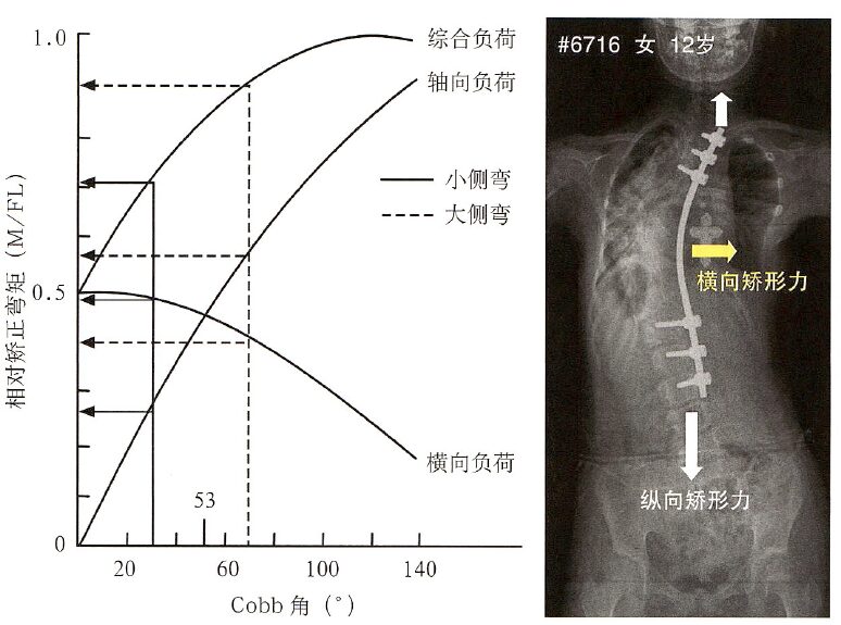 Biomechanics of Spinal Deformities