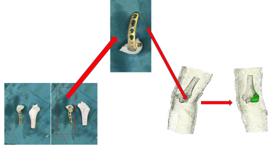Innovative Uses of 3D Printing in Trauma Orthopedic Surgery