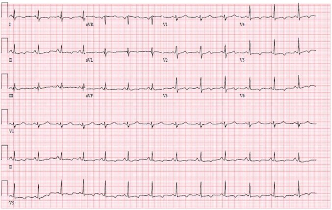 Desmoplakin Cardiomyopathy Mimicking Viral Myocarditis