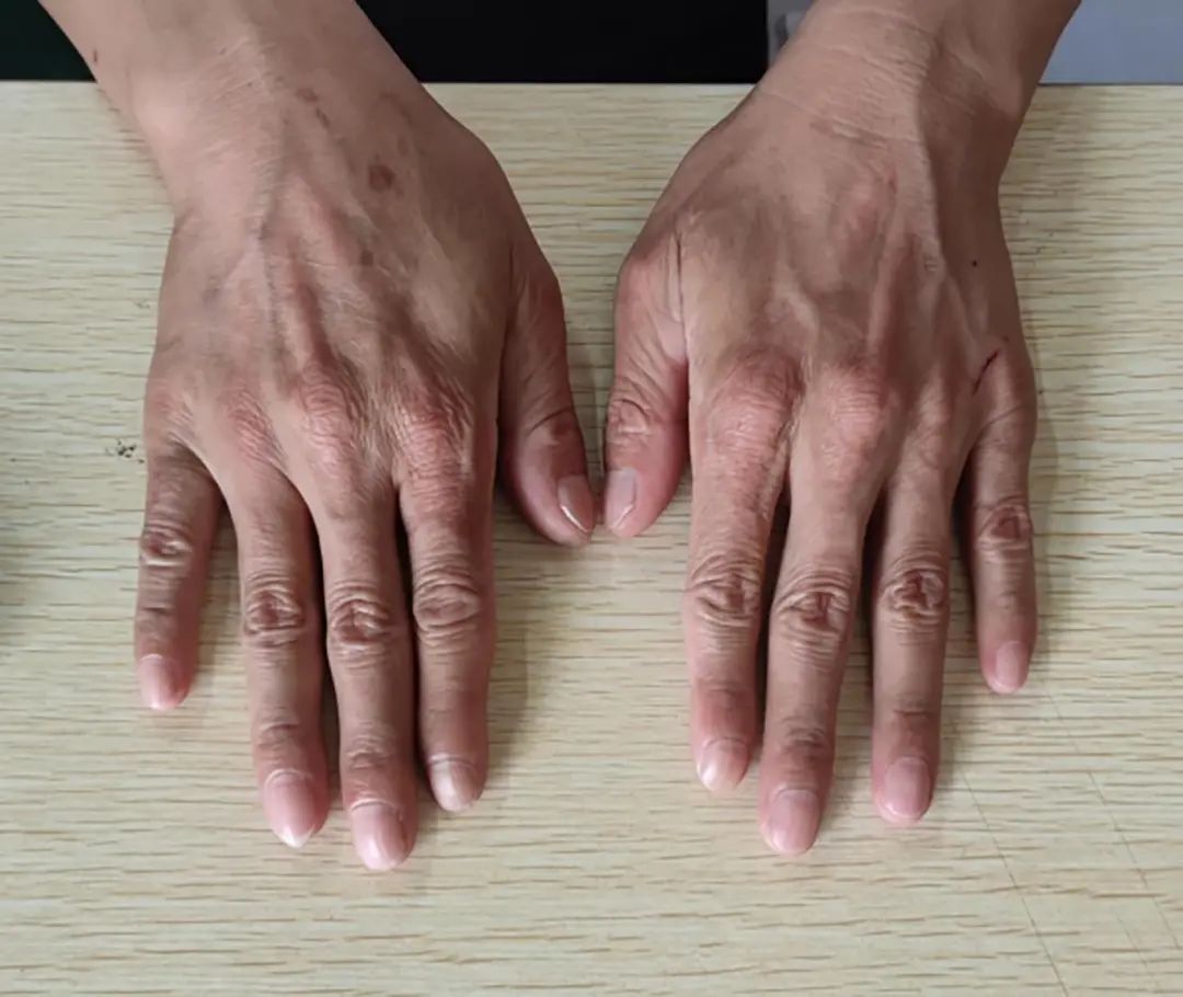 A Rare Case of Erythropoietic Protoporphyria with Liver Cirrhosis