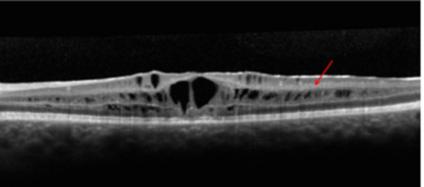 Professor Chen Juan: A Case of Unusual Pediatric Macular Degeneration