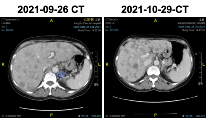 Case Sharing of ADC: A HER2-Positive Breast Cancer Case