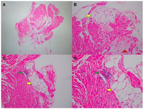 Desmoplakin Cardiomyopathy Mimicking Viral Myocarditis