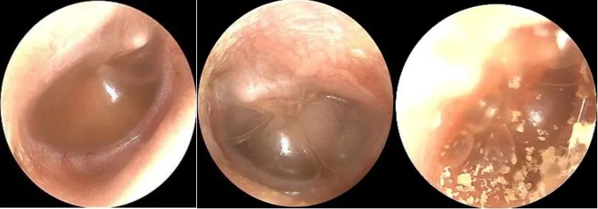 The Past and Present of Secretory Otitis Media in Children