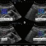 The Role of Shear Wave Elastography in Diagnosing Chronic Pancreatitis