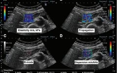 The Role of Shear Wave Elastography in Diagnosing Chronic Pancreatitis