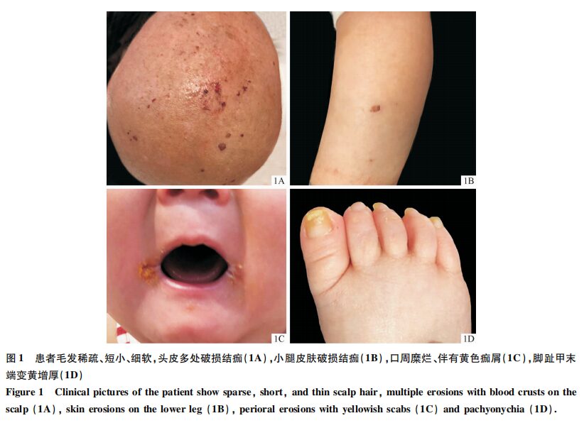 Case Report on Skin Fragility and Woolly Hair Syndrome Due to DSP Gene Mutation