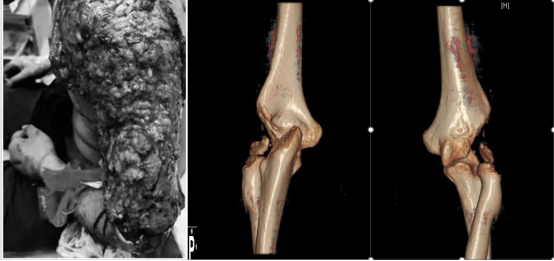 Innovative Uses of 3D Printing in Trauma Orthopedic Surgery