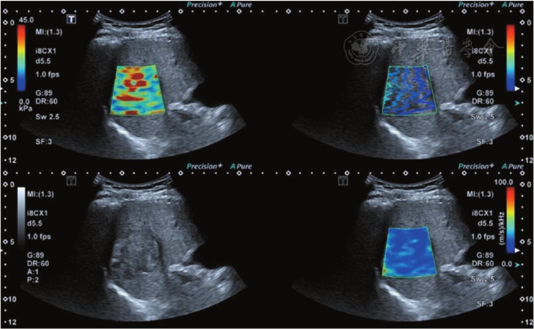 Preliminary Application of Shear Wave Dispersion Imaging in Differentiating Benign and Malignant Liver Tumors