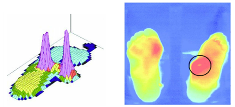 Current Research Status of Diabetic Foot Protection Techniques and Foot Aids