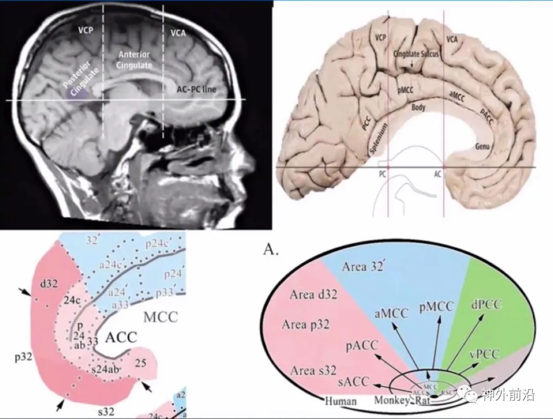 Cingulate Cortex Epilepsy and Surgical Treatment