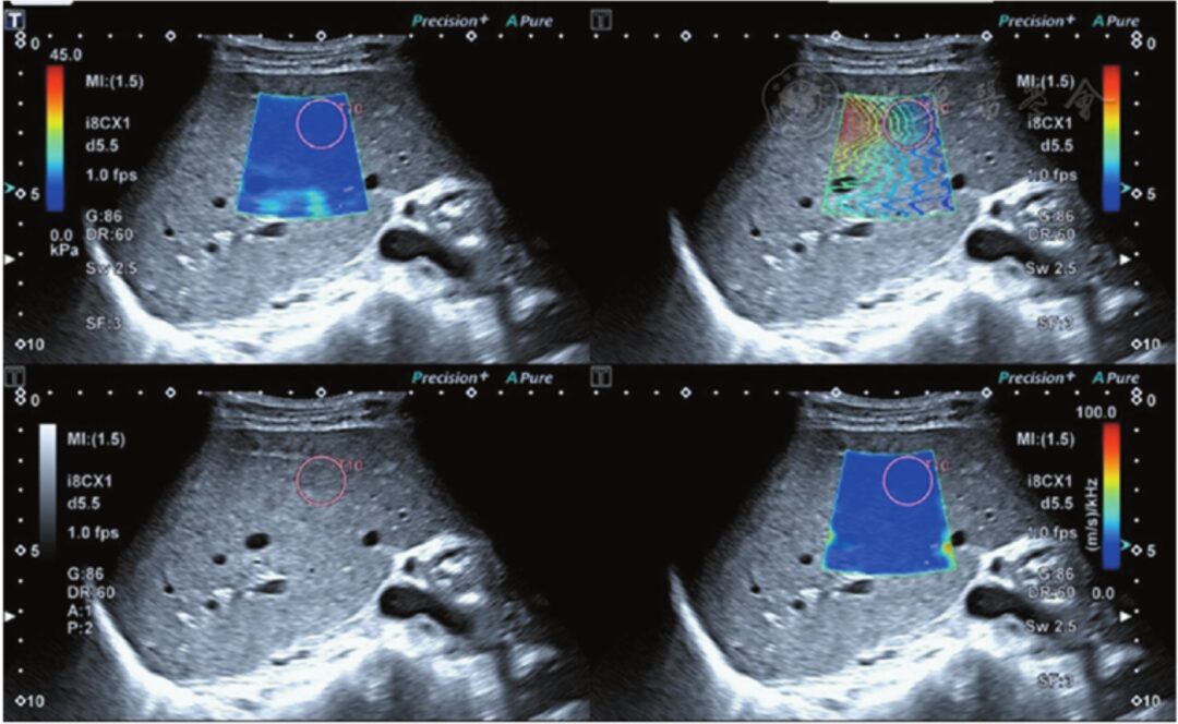 Preliminary Application of Shear Wave Dispersion Imaging in Differentiating Benign and Malignant Liver Tumors