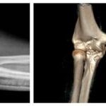 3D Printing Technology for Precise Treatment of Severe Fractures