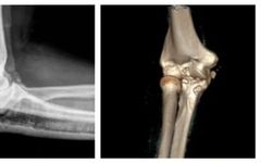 3D Printing Technology for Precise Treatment of Severe Fractures