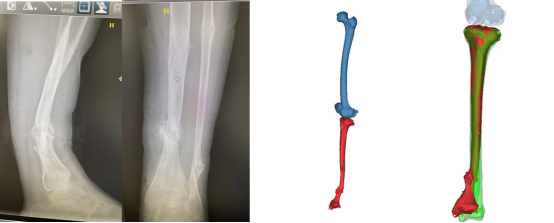 Innovative Uses of 3D Printing in Trauma Orthopedic Surgery