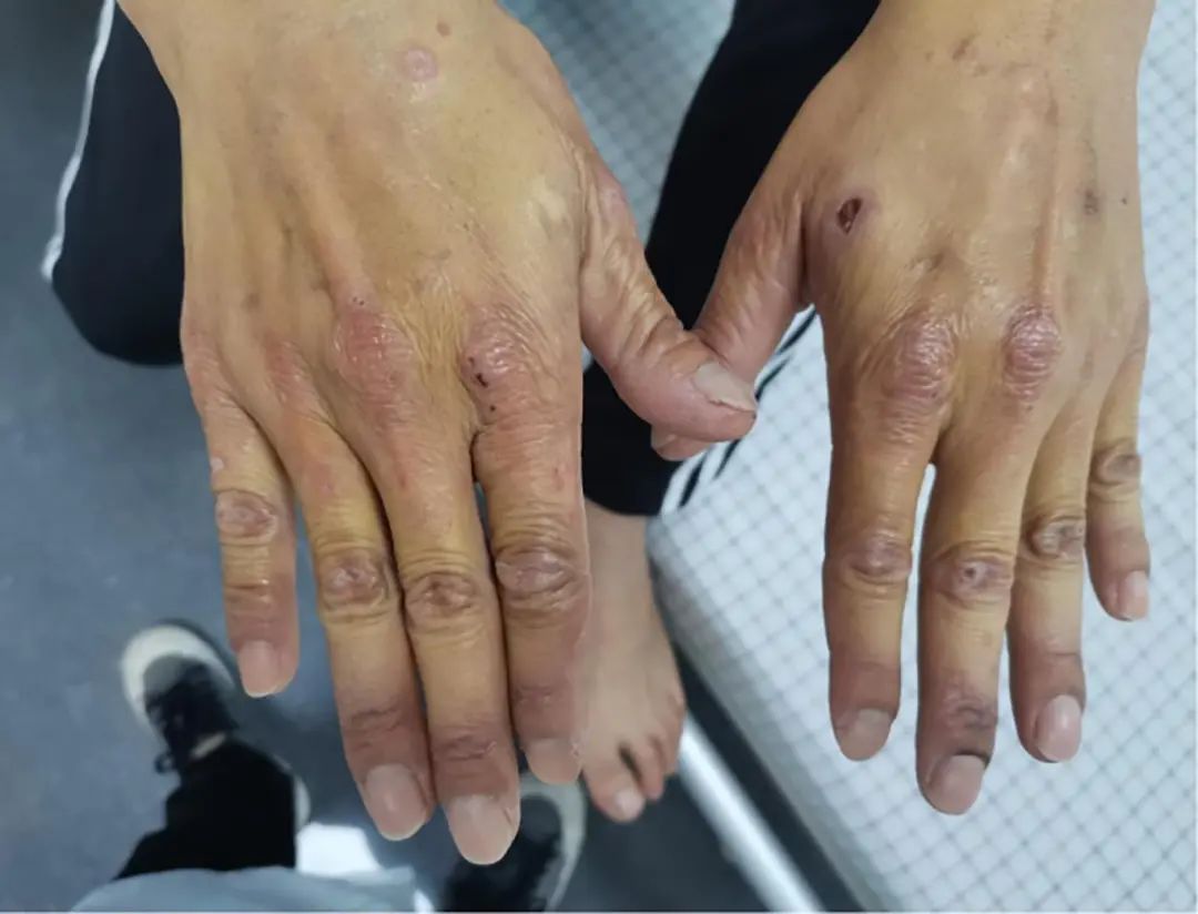 A Rare Case of Erythropoietic Protoporphyria with Liver Cirrhosis