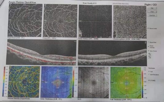 Professor Chen Juan: A Case of Unusual Pediatric Macular Degeneration