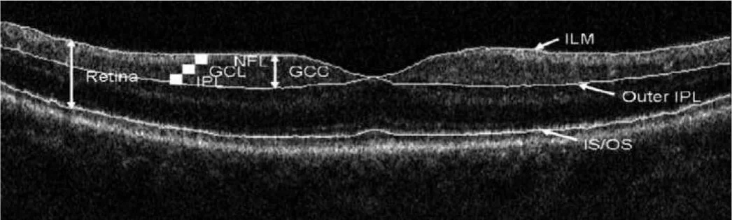 GCC and GCA | Measurement of Ganglion Cell Complex Thickness