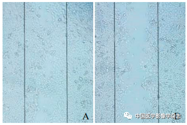 Inhibition of Breast Cancer Cells by Novel Nanoparticles Combined with Low-Intensity Focused Ultrasound