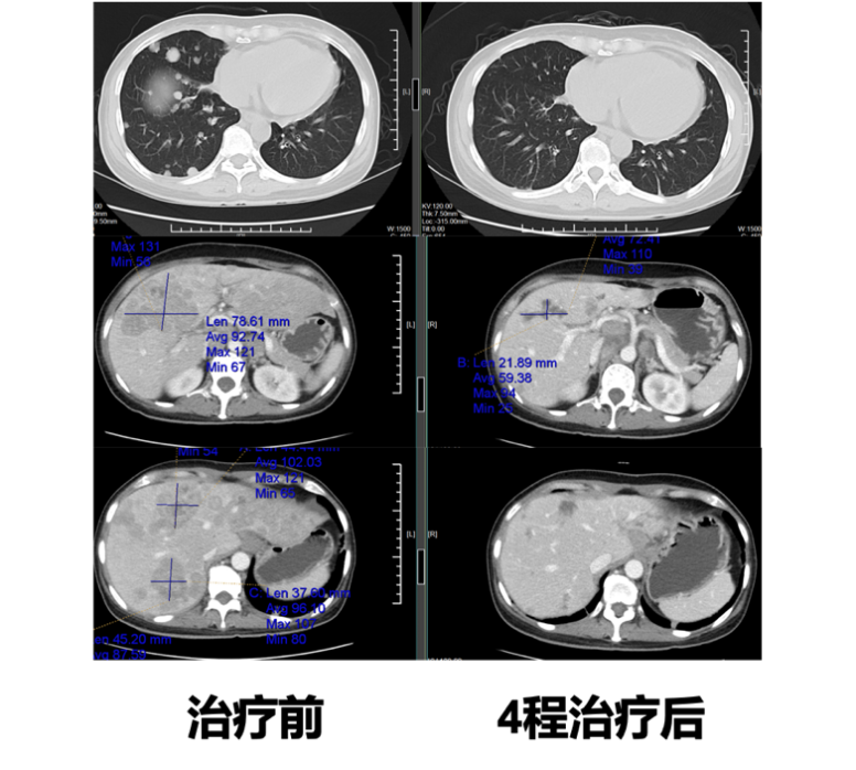 ADC Case Study: Overcoming Metastatic Breast Cancer