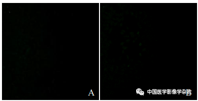 Inhibition of Breast Cancer Cells by Novel Nanoparticles Combined with Low-Intensity Focused Ultrasound