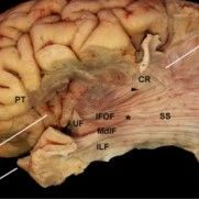 Study of the Superior Frontal Gyrus and Its White Matter Connections