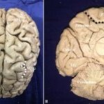 Study of the Superior Frontal Gyrus and Its White Matter Connections