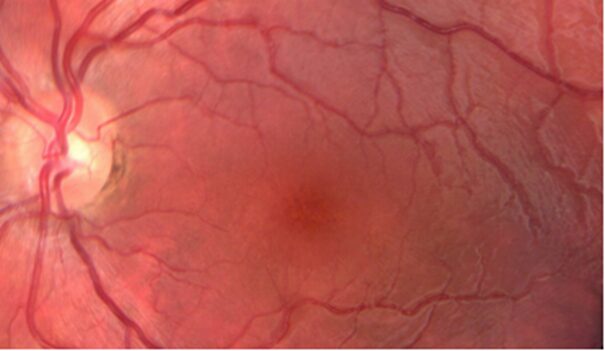 Professor Chen Juan: A Case of Unusual Pediatric Macular Degeneration