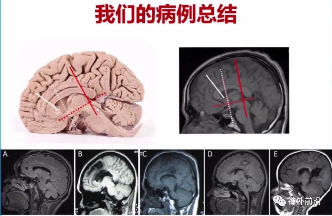 Cingulate Cortex Epilepsy and Surgical Treatment