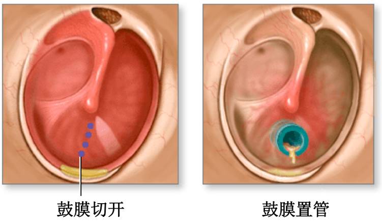 Clinical Study on Retention Time and Recurrence After Tympanostomy in Children