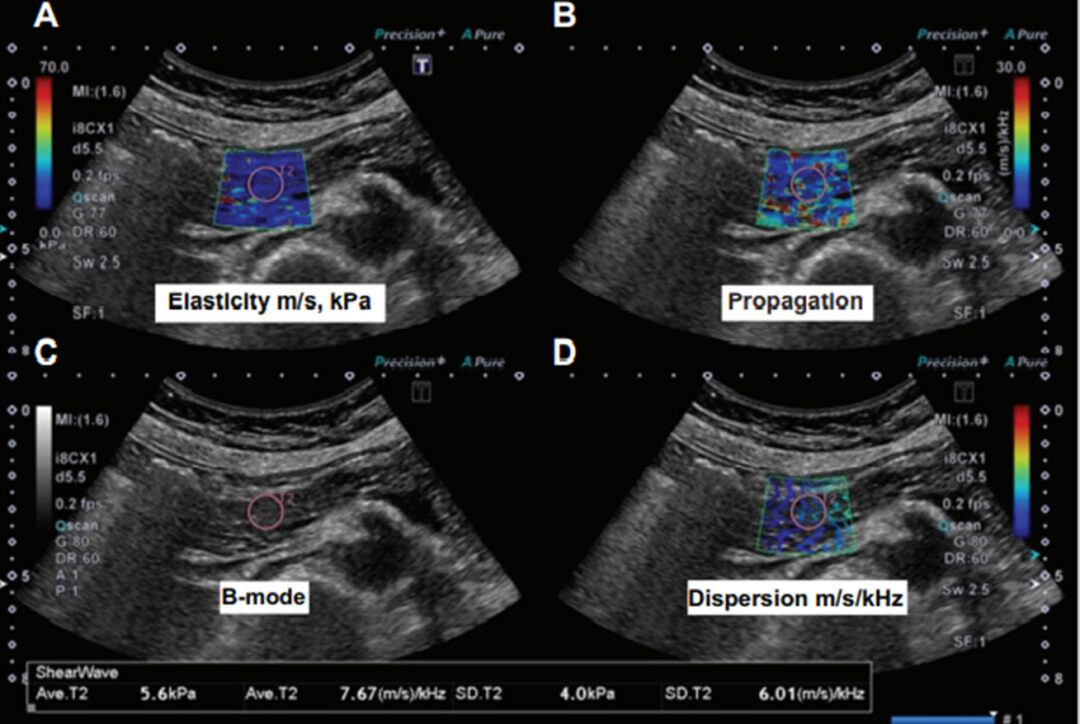 The Role of Shear Wave Elastography in Diagnosing Chronic Pancreatitis