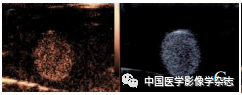 Inhibition of Breast Cancer Cells by Novel Nanoparticles Combined with Low-Intensity Focused Ultrasound