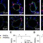 Smooth Muscle Acid-Sensing Ion Channel 1a as a Therapeutic Target to Reverse Hypoxic Pulmonary Hypertension