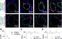 Smooth Muscle Acid-Sensing Ion Channel 1a as a Therapeutic Target to Reverse Hypoxic Pulmonary Hypertension