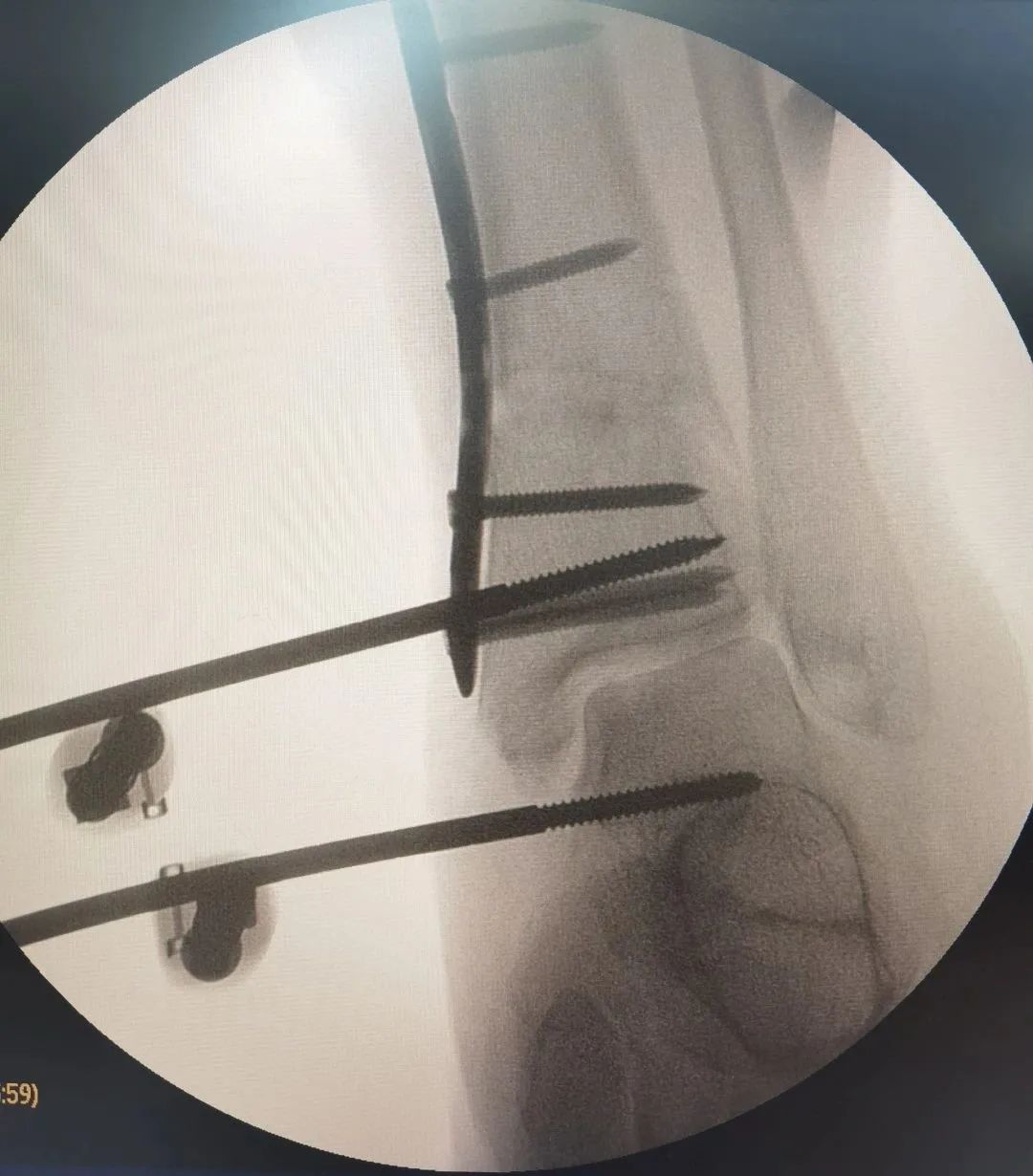 3D Printing Technology for Precise Treatment of Severe Fractures