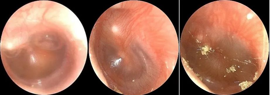 The Past and Present of Secretory Otitis Media in Children