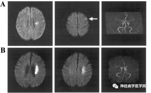 Types of Infarction in Perforating Artery Disease and Advances in Neuroimaging Research