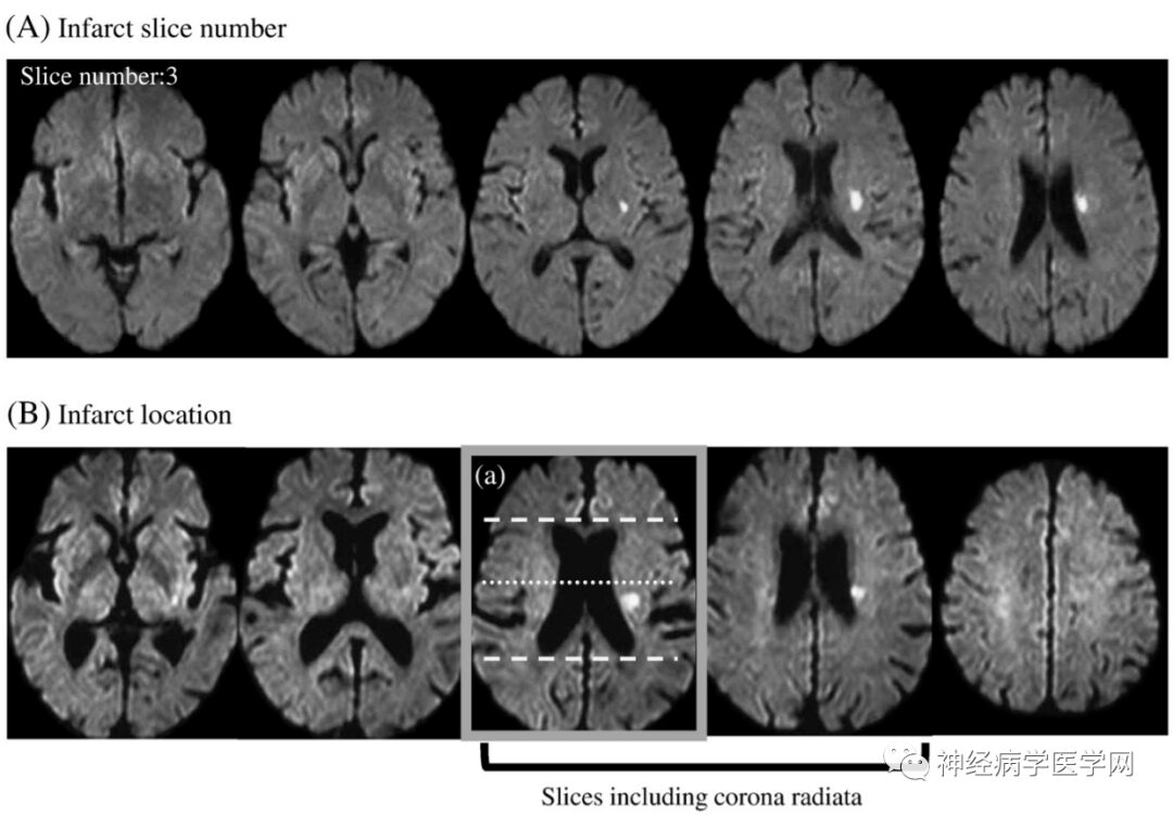 Types of Infarction in Perforating Artery Disease and Advances in Neuroimaging Research