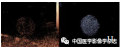 Inhibition of Breast Cancer Cells by Novel Nanoparticles Combined with Low-Intensity Focused Ultrasound