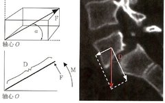 Biomechanics of Spinal Deformities