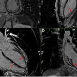 Desmoplakin Cardiomyopathy Mimicking Viral Myocarditis