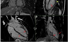 Desmoplakin Cardiomyopathy Mimicking Viral Myocarditis