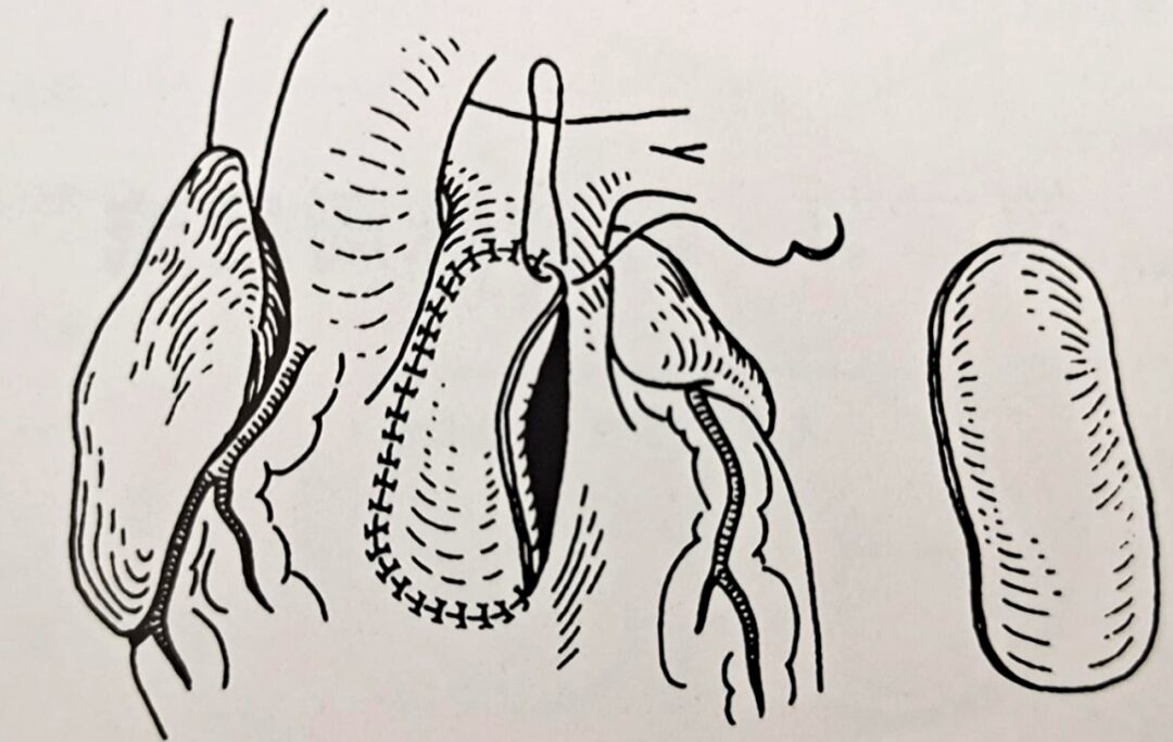 Understanding Pulmonary Valve Regurgitation